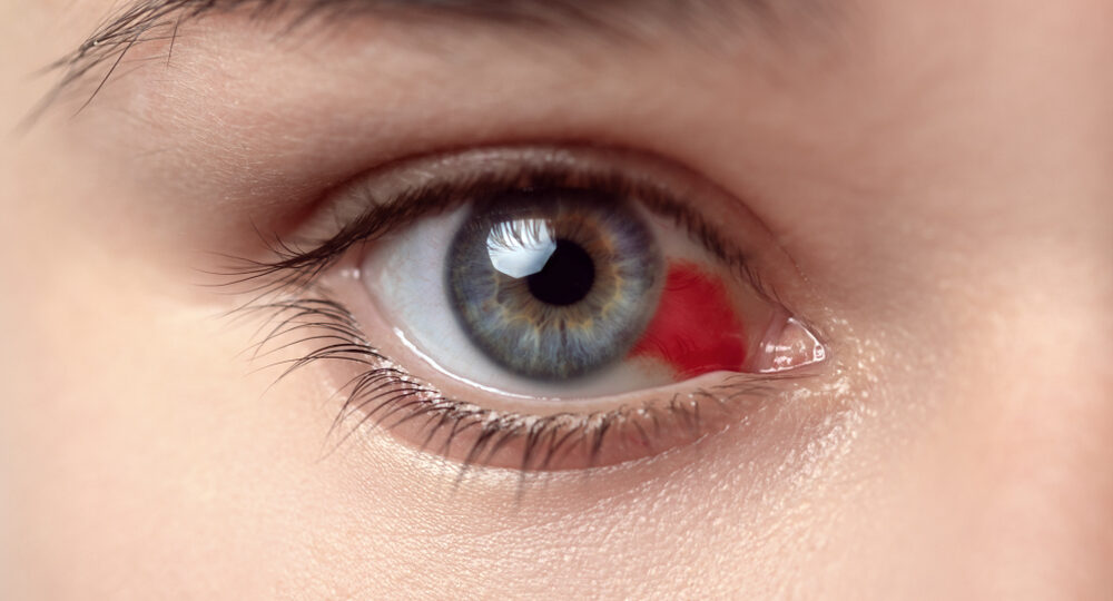 Bloodshot,Eye.,Woman,With,Burst,Blood,Vessel,In,Eye.,Very
