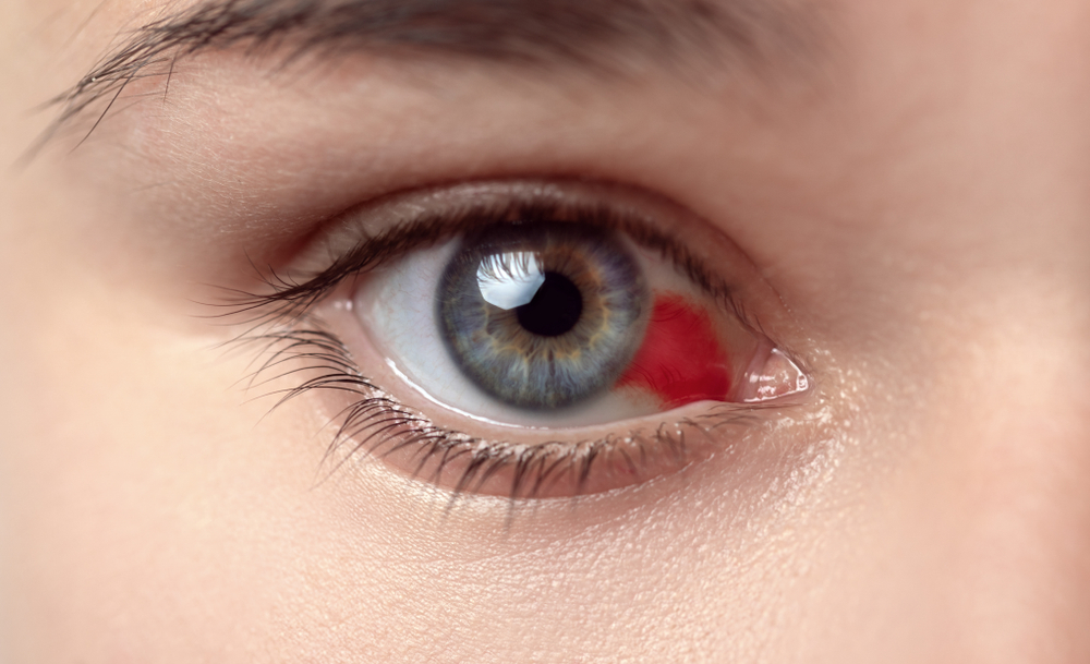 Bloodshot,Eye.,Woman,With,Burst,Blood,Vessel,In,Eye.,Very