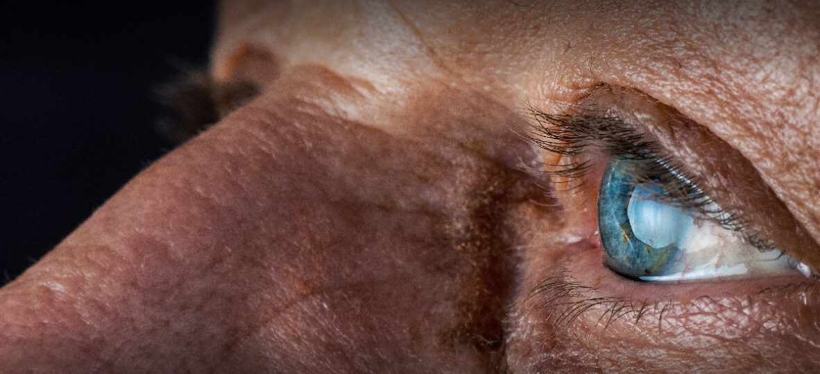 Complications in Cataract Surgery at APACRS 2024 02