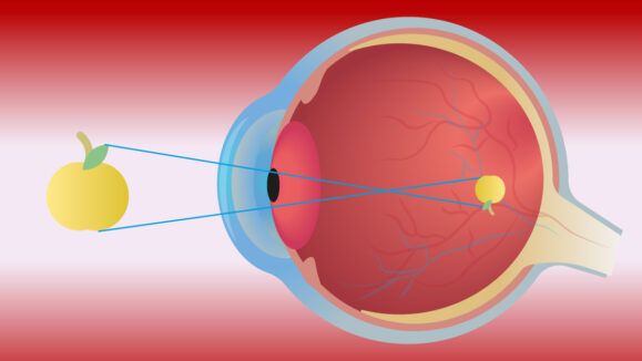 REFRACTIVE ERRORS 02