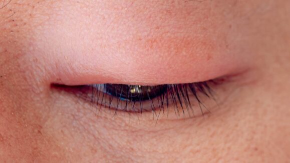 Understanding and Managing Primary Angle Closure in Asian Populations