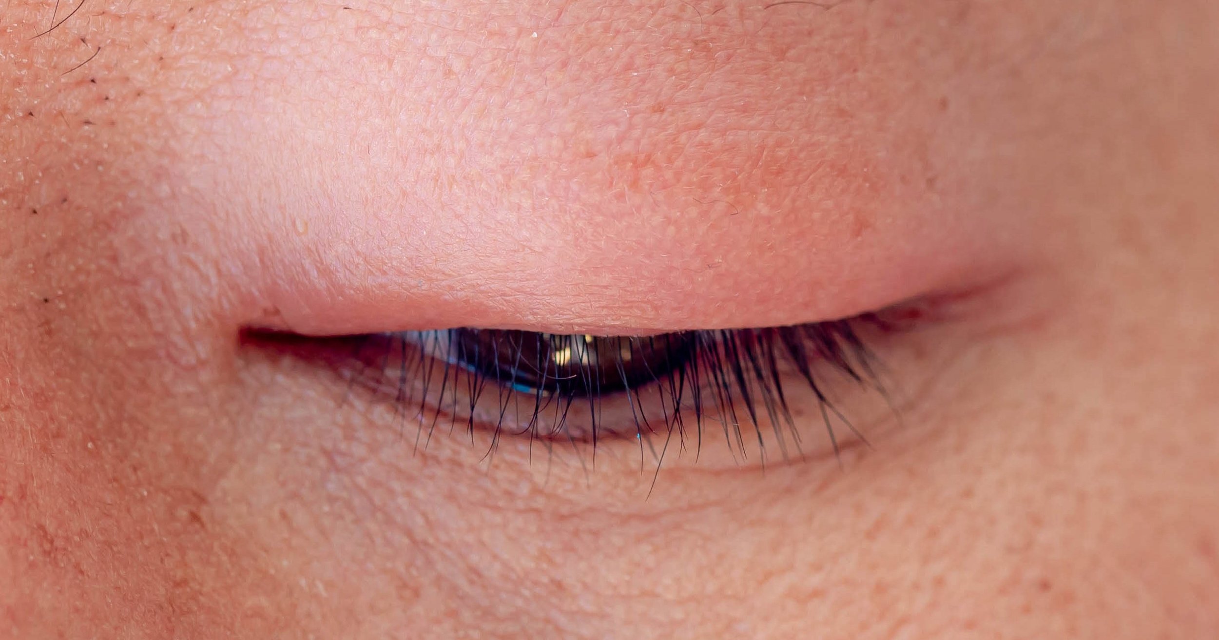 Understanding and Managing Primary Angle Closure in Asian Populations