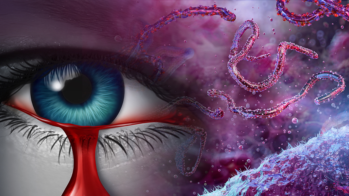 thumbnail website _ Bleeding Eye Disease A Looming Global Health Crisis _ 1200x675