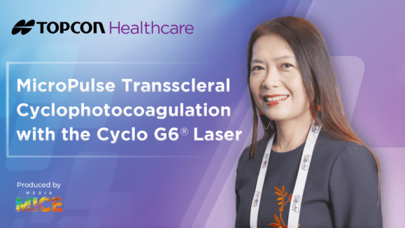 [Topcon] APGC KOL interview Dr. Ho Ching Lin thumbnail MicroPulse Transscleral Cyclophotocoagulation with the Cyclo G6 Laser (1)